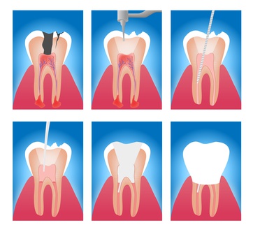 infographic stages of root canal treatment vector
